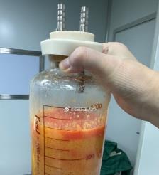 响水水动力吸脂手术要做多久？